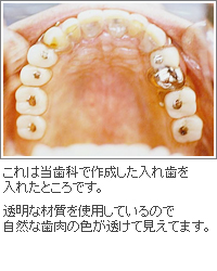 一生使える入れ歯