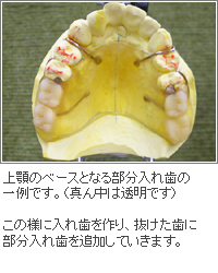 一生使える入れ歯